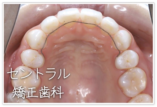 裏側矯正