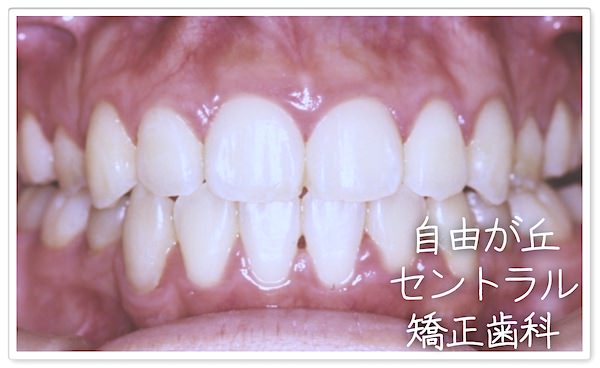 叢生矯正