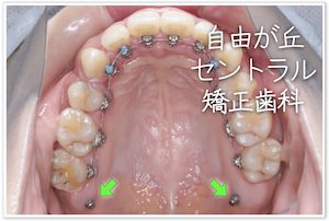 インプラント矯正