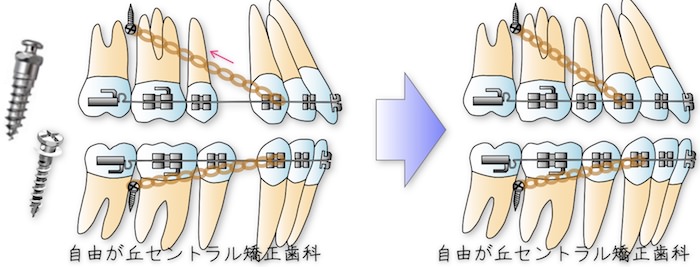 インプラント矯正